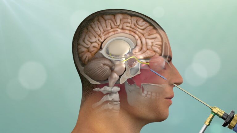 14-190_SAINT-JOHNS-KEYHOLE-SURGERY_ENDONASAL-Adenoma1 14-190_SAINT-JOHNS-KEYHOLE-SURGERY_ENDONASAL-Adenoma1