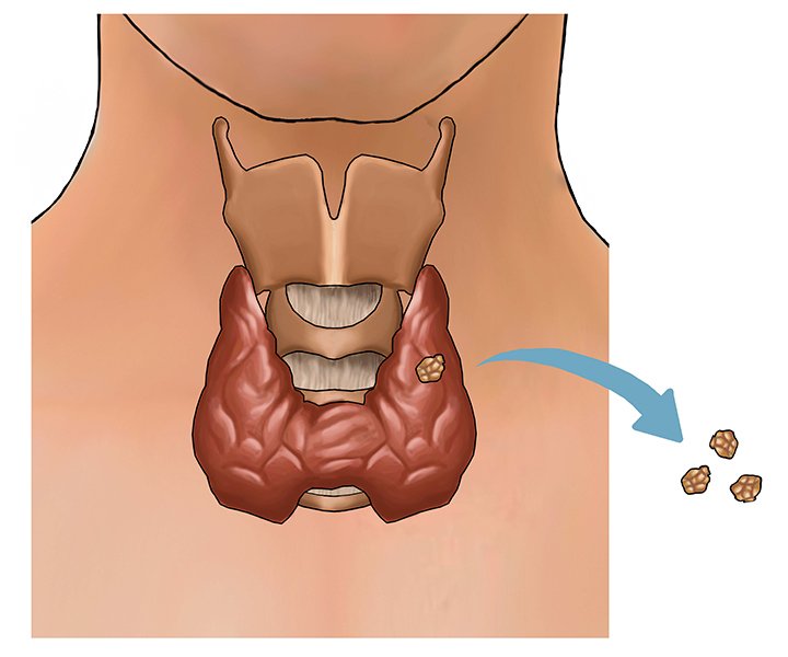 Parathyroidectomy Parathyroidectomy