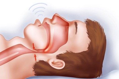 sleep-apnoea sleep-apnoea